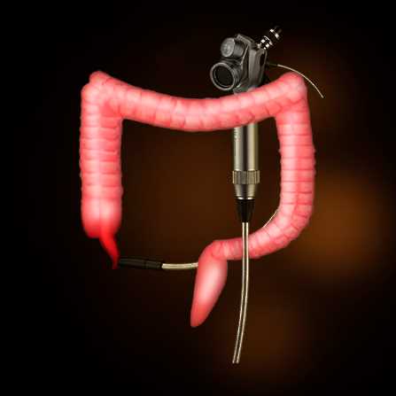 Laproscopic Appendectomy